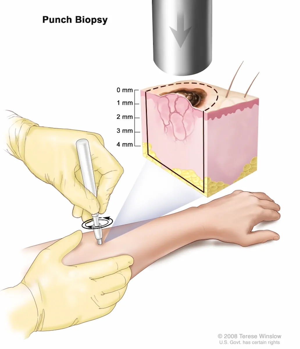 ilustrasi punch biopsy.webp